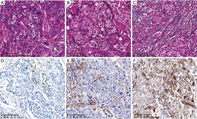 Narrative review of progress in pathological diagnosis of breast cancer.