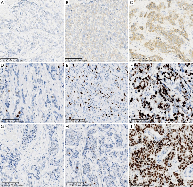 Narrative review of progress in pathological diagnosis of breast cancer.