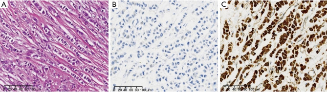 Narrative review of progress in pathological diagnosis of breast cancer.