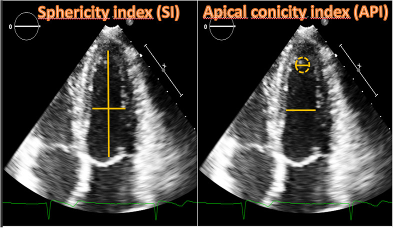 Difference in cardiac remodeling between female athletes and pregnant women: a case control study.