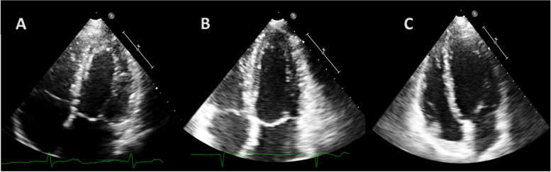 Difference in cardiac remodeling between female athletes and pregnant women: a case control study.