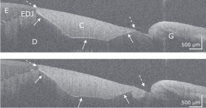 OCT Evaluation of Marginal and Internal Interface Integrity of Class V Composite Restorations after 36 to 48 Months.