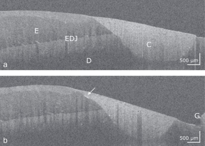 OCT Evaluation of Marginal and Internal Interface Integrity of Class V Composite Restorations after 36 to 48 Months.