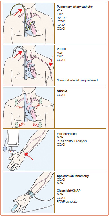 Contemporary Review of Hemodynamic Monitoring in the Critical Care Setting.