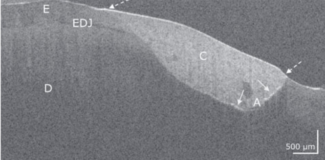OCT Evaluation of Marginal and Internal Interface Integrity of Class V Composite Restorations after 36 to 48 Months.