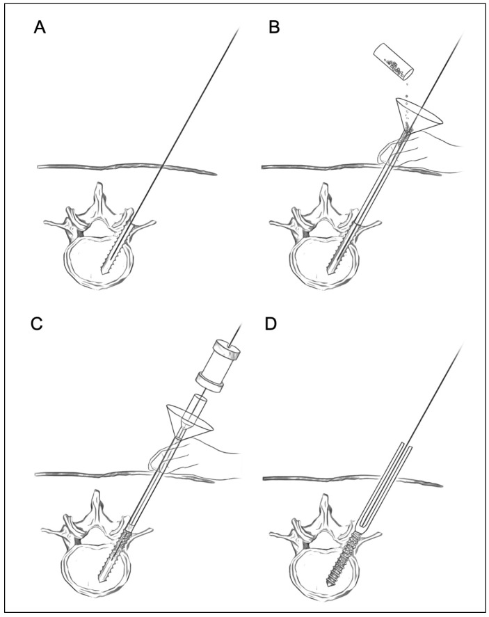Reinforcement of Percutaneous Pedicle Screw Fixation with Hydroxyapatite Granules in Patients with Osteoporotic Spine: Biomechanical Performance and Clinical Outcomes.