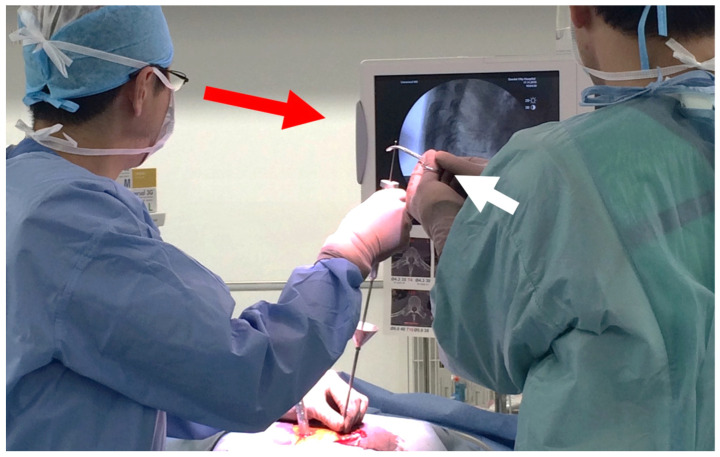 Reinforcement of Percutaneous Pedicle Screw Fixation with Hydroxyapatite Granules in Patients with Osteoporotic Spine: Biomechanical Performance and Clinical Outcomes.