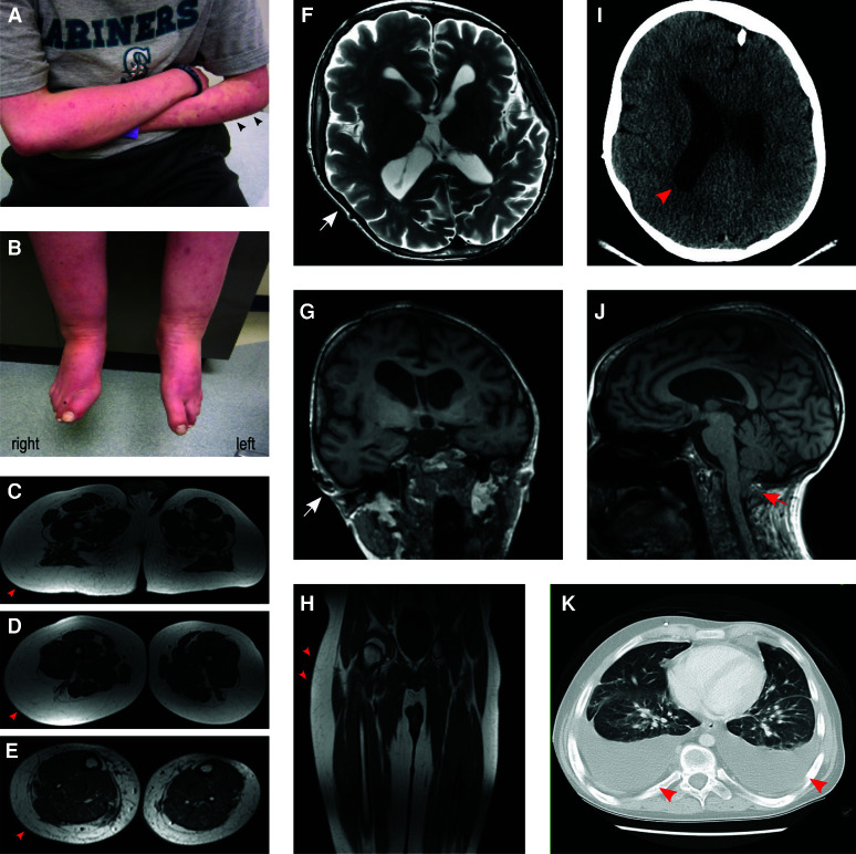 The utility of cerebrospinal fluid-derived cell-free DNA in molecular diagnostics for the <i>PIK3CA</i>-related megalencephaly-capillary malformation (MCAP) syndrome: a case report.