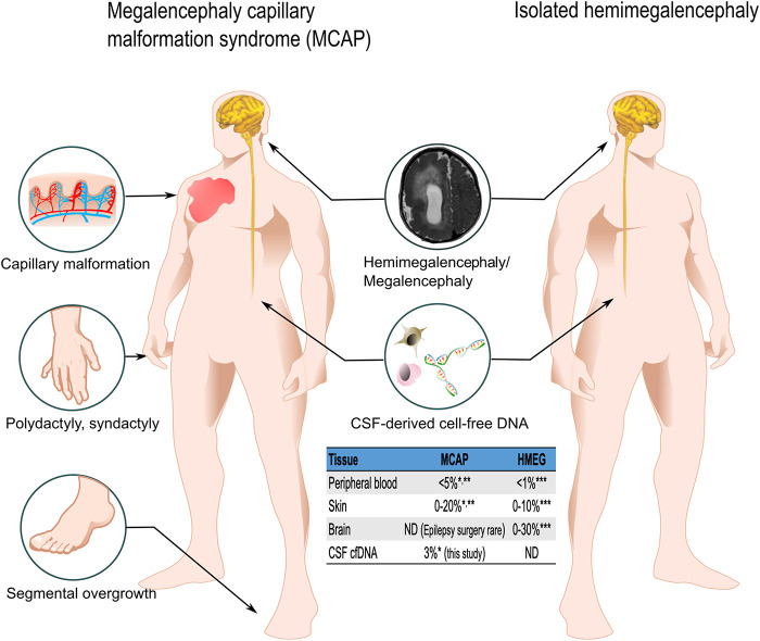 The utility of cerebrospinal fluid-derived cell-free DNA in molecular diagnostics for the <i>PIK3CA</i>-related megalencephaly-capillary malformation (MCAP) syndrome: a case report.