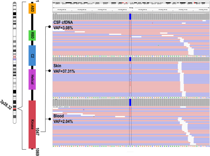 The utility of cerebrospinal fluid-derived cell-free DNA in molecular diagnostics for the <i>PIK3CA</i>-related megalencephaly-capillary malformation (MCAP) syndrome: a case report.