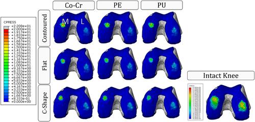 Finite element analysis of tibio-femoral contact mechanics of a customised knee spacer