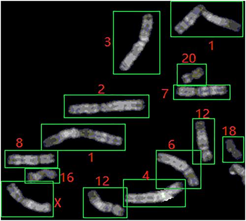 SRAS-net: Low-resolution chromosome image classification based on deep learning