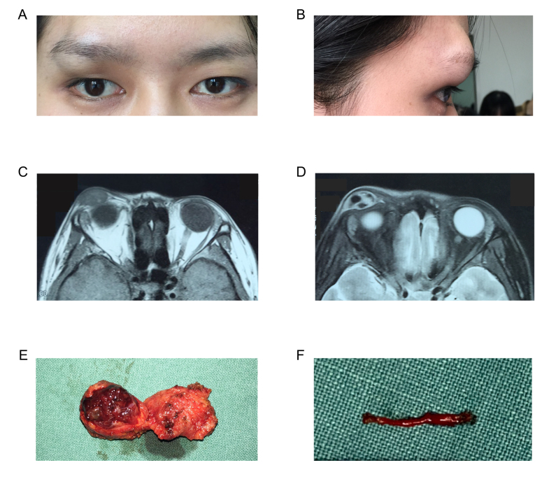 Comprehensive circular RNA expression profiling with associated ceRNA network in orbital venous malformation.