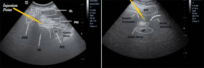 Spinal anesthesia versus combined sciatic nerve/lumbar plexus nerve block in elderly patients undergoing total hip arthroplasty: a retrospective study.