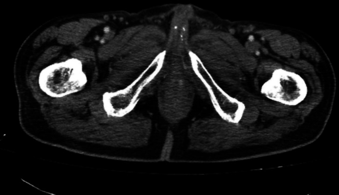 Calcified Peyronie's Disease Frequency on Computed Tomography.