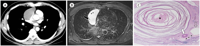 [Mediastinal Teratoma: A Pictorial Essay].