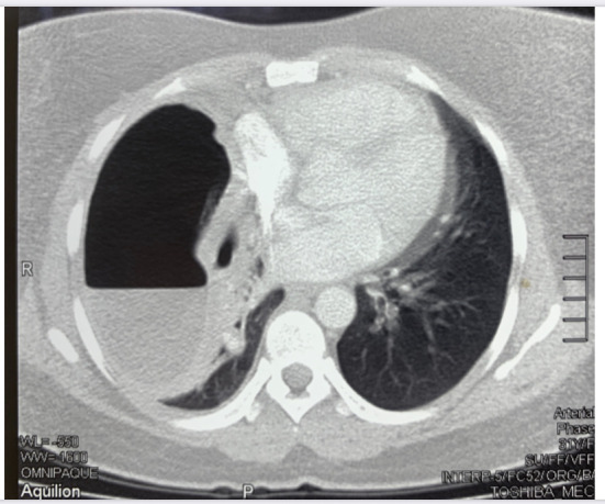 Percutaneous catheter drainage of a pyogenic lung abscess: A case report.