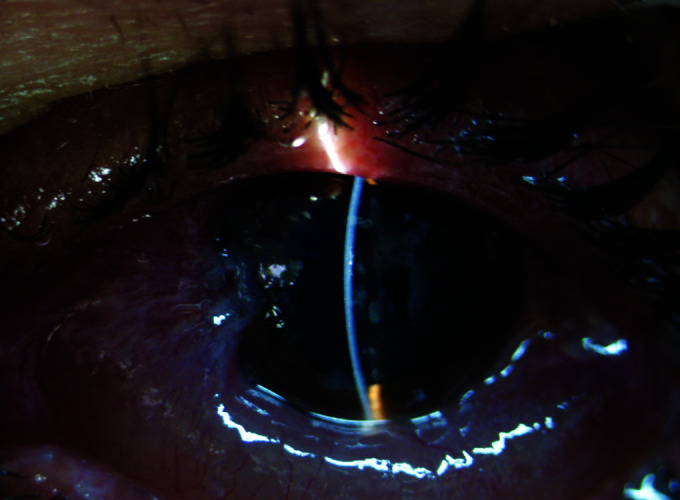 Efficacy of the XEN45 Implant in Advanced to End-stage Glaucoma Patients.