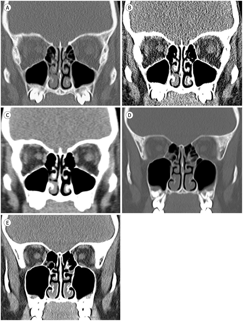 Feasibility of Pediatric Low-Dose Facial CT Reconstructed with Filtered Back Projection Using Adequate Kernels.