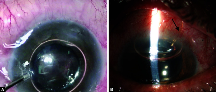 Efficacy of the XEN45 Implant in Advanced to End-stage Glaucoma Patients.