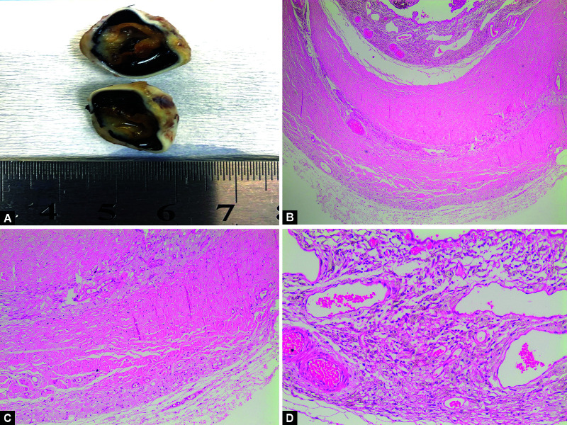 Juvenile Xanthogranuloma Presented with Buphthalmos and Corneal Clouding in Neonatal Period: A Case Report.