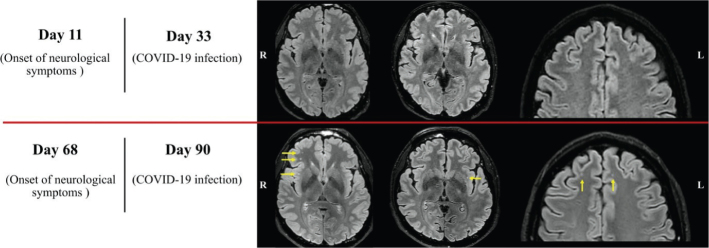 Can diffusion tensor imaging (DTI) outperform standard magnetic resonance imaging (MRI) investigations in post-COVID-19 autoimmune encephalitis?