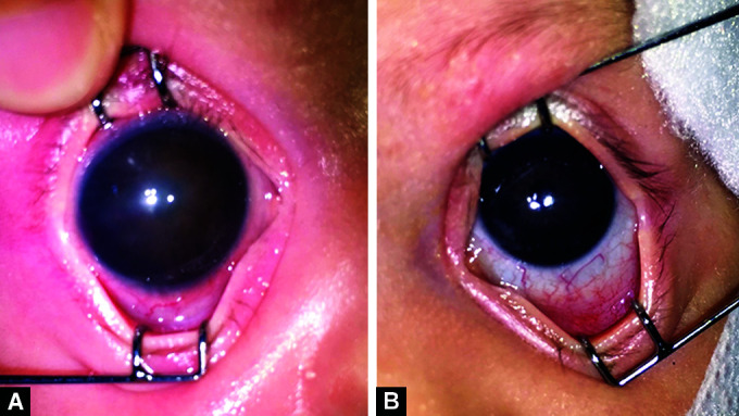 Juvenile Xanthogranuloma Presented with Buphthalmos and Corneal Clouding in Neonatal Period: A Case Report.