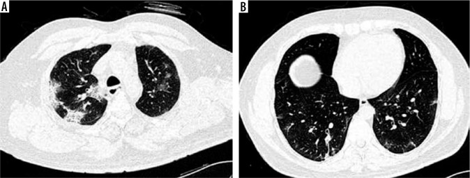 Comparative evaluation of severity of COVID-19 pneumonia on computed tomography of the chest in vaccinated and non-vaccinated individuals: an observational study.