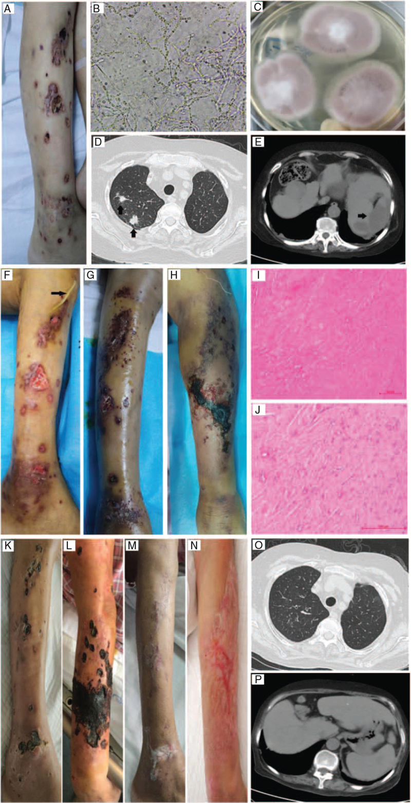 Complicated multiple organ infection of <i>Purpureocillium lilacinum</i> and varicella-zoster virus infection in a patient with Evans' syndrome.