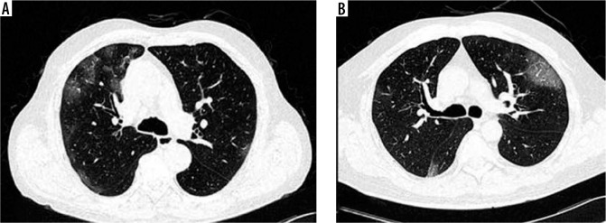 Comparative evaluation of severity of COVID-19 pneumonia on computed tomography of the chest in vaccinated and non-vaccinated individuals: an observational study.