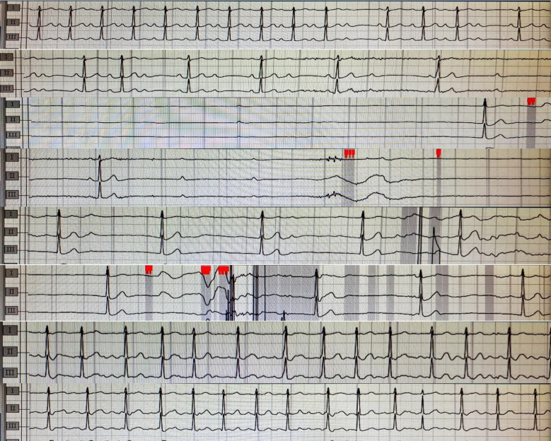 Atrioventricular (AV) block and sinus arrest associated with dipyridamole infusion.