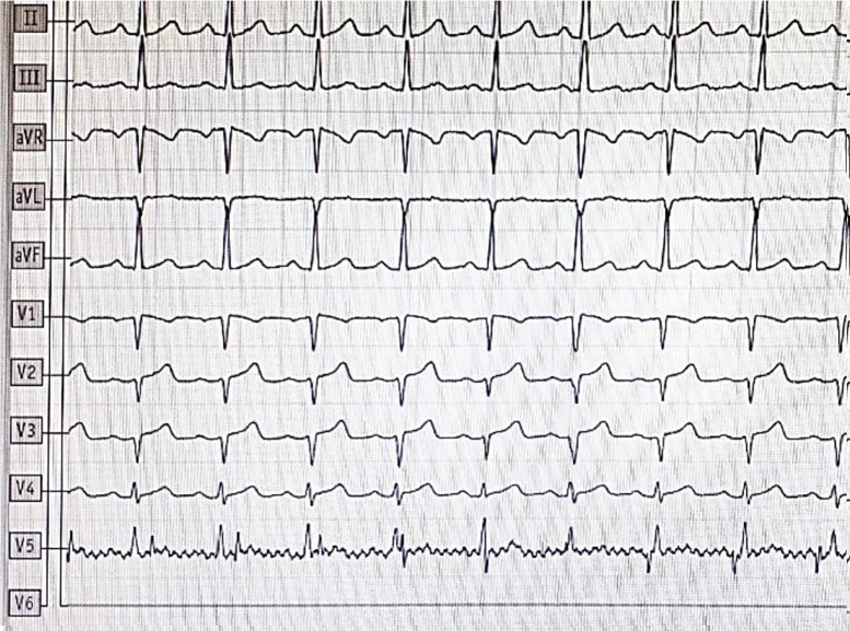 Atrioventricular (AV) block and sinus arrest associated with dipyridamole infusion.