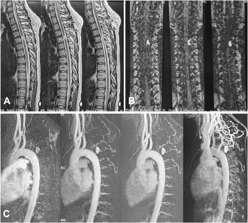 Onyx embolization of a spinal epidural hemorrhage caused by thoracic spinal epidural arteriovenous fistula: A case report and literature review