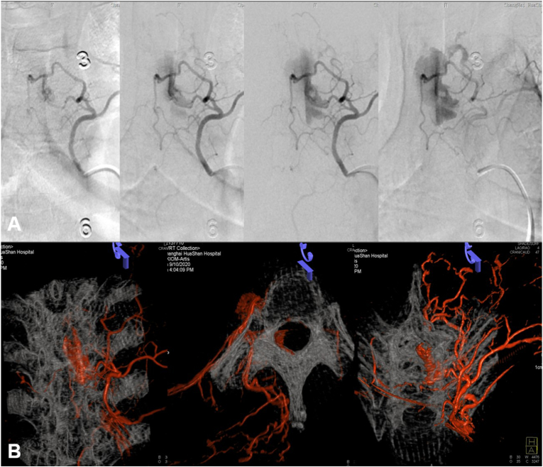 Onyx embolization of a spinal epidural hemorrhage caused by thoracic spinal epidural arteriovenous fistula: A case report and literature review