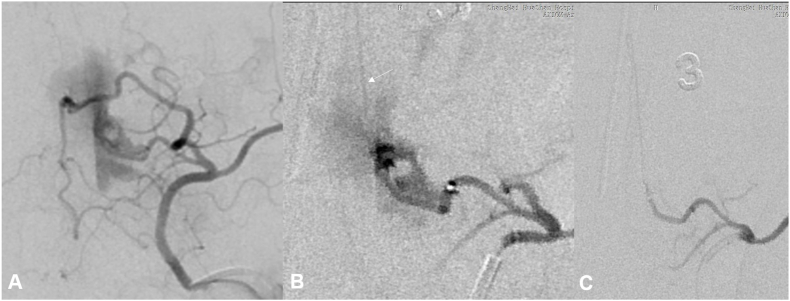 Onyx embolization of a spinal epidural hemorrhage caused by thoracic spinal epidural arteriovenous fistula: A case report and literature review