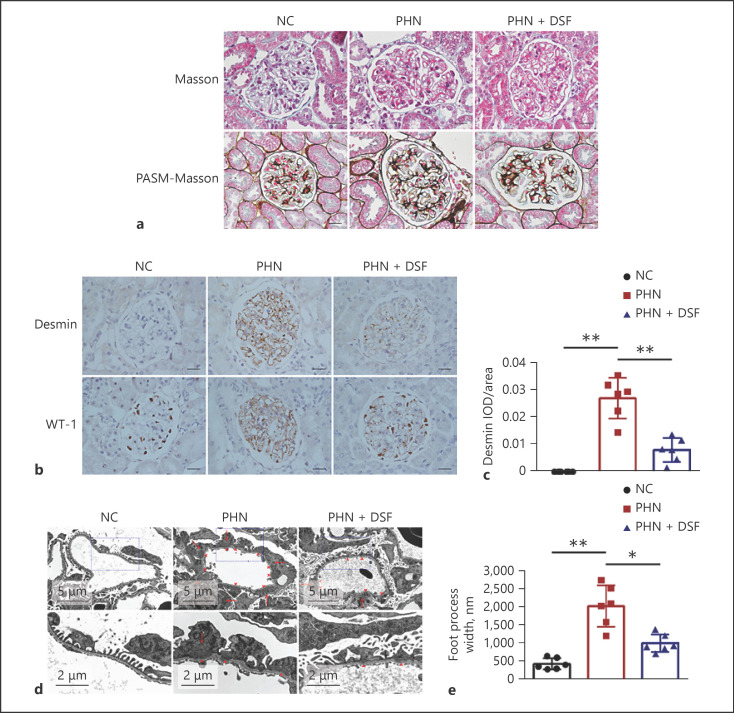 Treatment of Membranous Nephropathy by Disulfiram through Inhibition of Podocyte Pyroptosis.