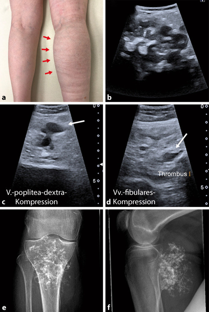 [Uncommon tumor-associated deep vein thrombosis].