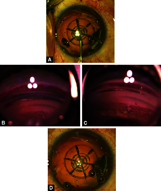 Efficacy and Safety of iStent Inject Implantation in Manual and Femtosecond Laser-assisted Cataract Surgery before Lens Extraction.