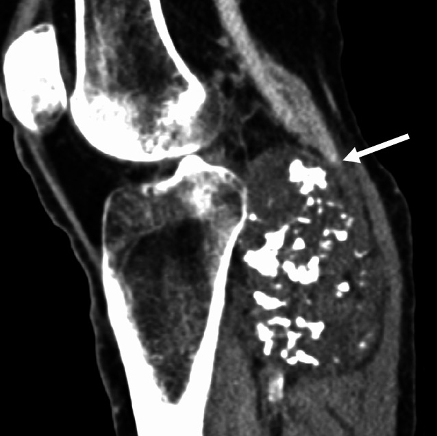 [Uncommon tumor-associated deep vein thrombosis].