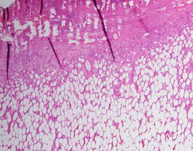 [Spontaneous expulsion of a mesenchymal colonic tumor via the rectum].