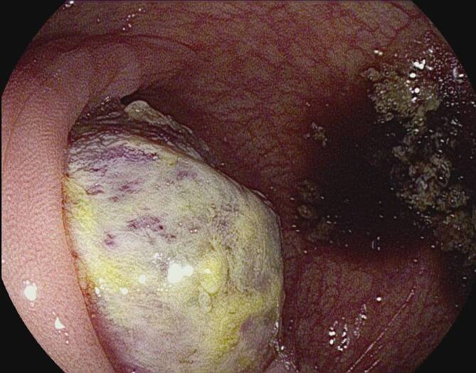 [Spontaneous expulsion of a mesenchymal colonic tumor via the rectum].