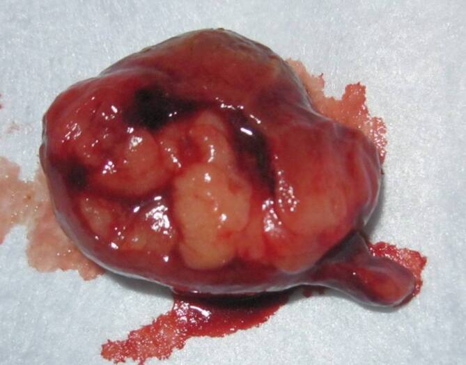 [Spontaneous expulsion of a mesenchymal colonic tumor via the rectum].