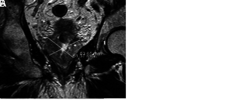 Clinical Outcomes of Prostatic Artery Embolization in Patients with Benign Prostatic Hyperplasia: A Prospective Clinical Study.