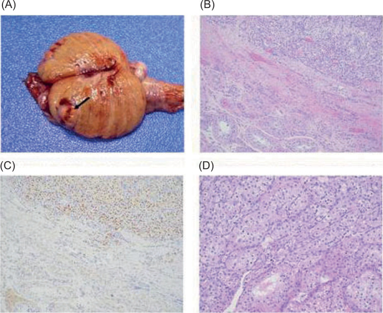 Renal Cell Carcinoma with Testicular Metastases: A Case Report and Review of the Literature.