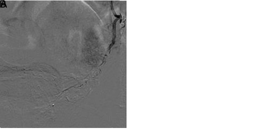 Clinical Outcomes of Prostatic Artery Embolization in Patients with Benign Prostatic Hyperplasia: A Prospective Clinical Study.