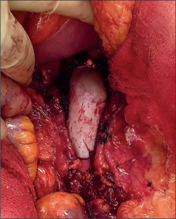 Tuberculosis Aortitis and Mycotic Pseudo-aneurysm of the Infra-renal Aorta after Intravesicular BCG Therapy.