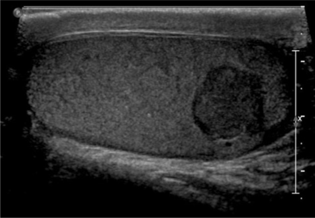 Renal Cell Carcinoma with Testicular Metastases: A Case Report and Review of the Literature.