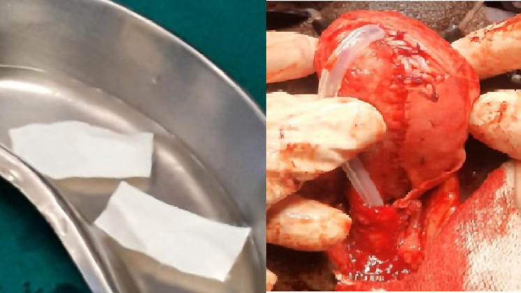 Acellular Tissue Engineered Pericardial Patch Urethroplasty: A New Horizon of Substitution Urethroplasty.