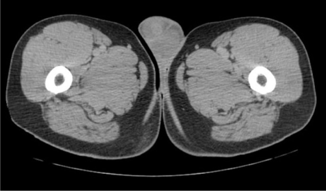 Renal Cell Carcinoma with Testicular Metastases: A Case Report and Review of the Literature.