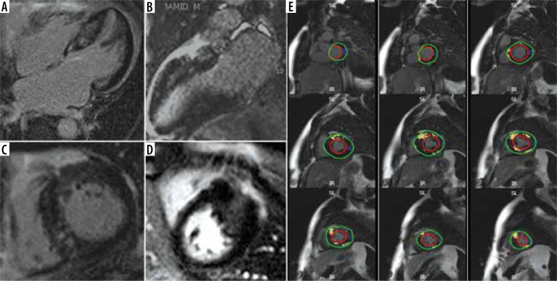 Feature-tracking cardiac magnetic resonance method: a valuable marker of replacement fibrosis in hypertrophic cardiomyopathy.